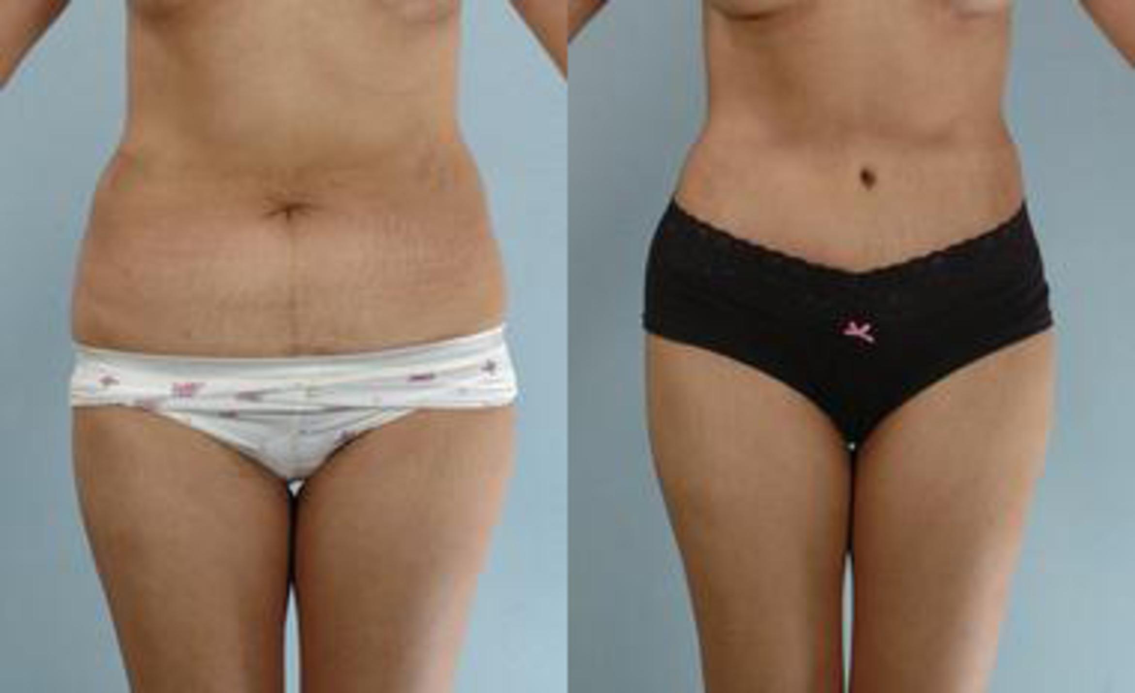 Before & After Liposuction Case 3283 View 1 View in Houston, TX
