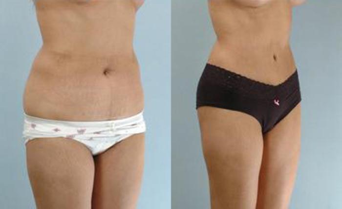 Before & After Liposuction Case 3283 View 2 View in Houston, TX
