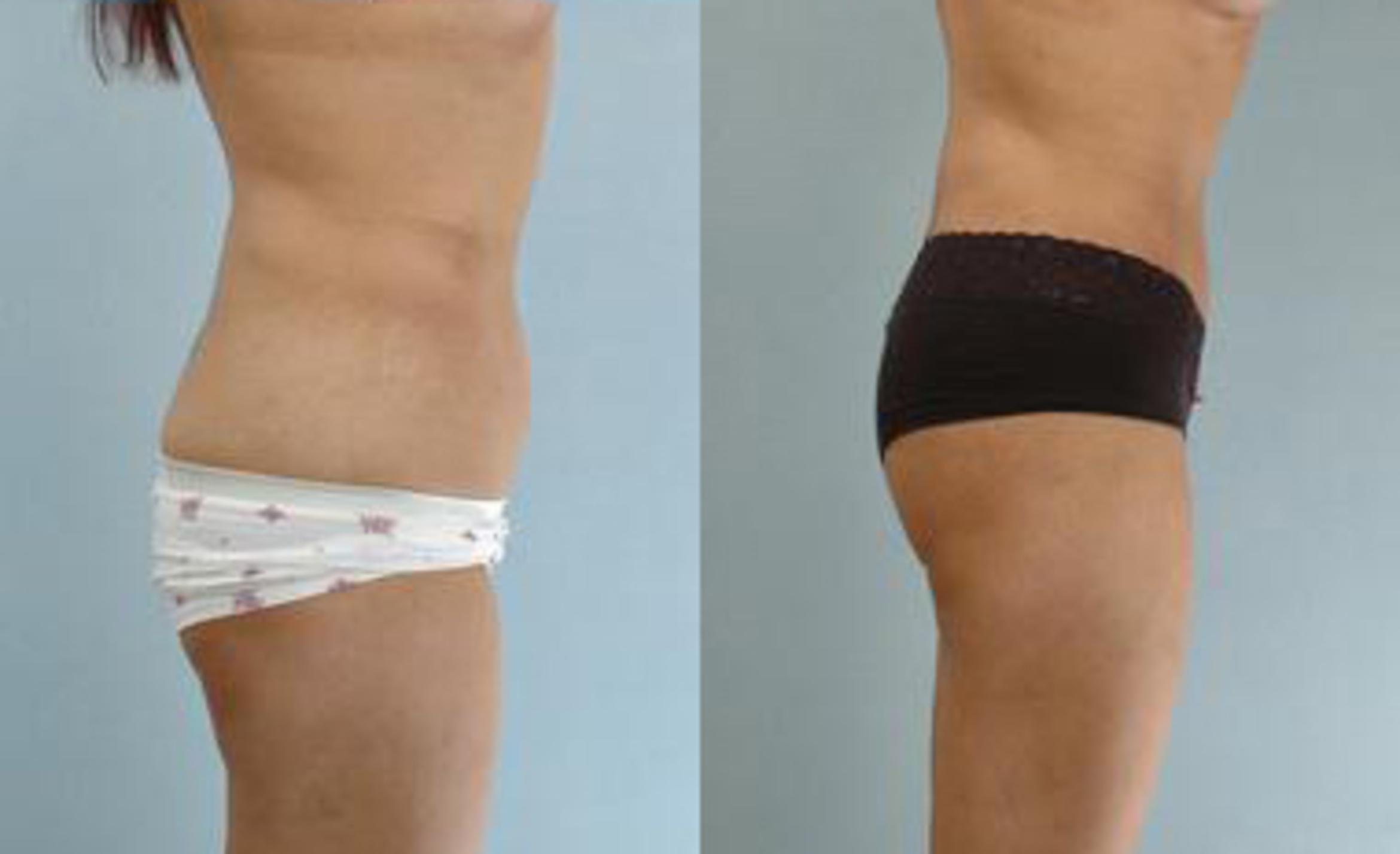 Before & After Liposuction Case 3283 View 3 View in Houston, TX