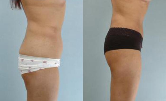 Before & After Liposuction Case 3283 View 3 View in Houston, TX
