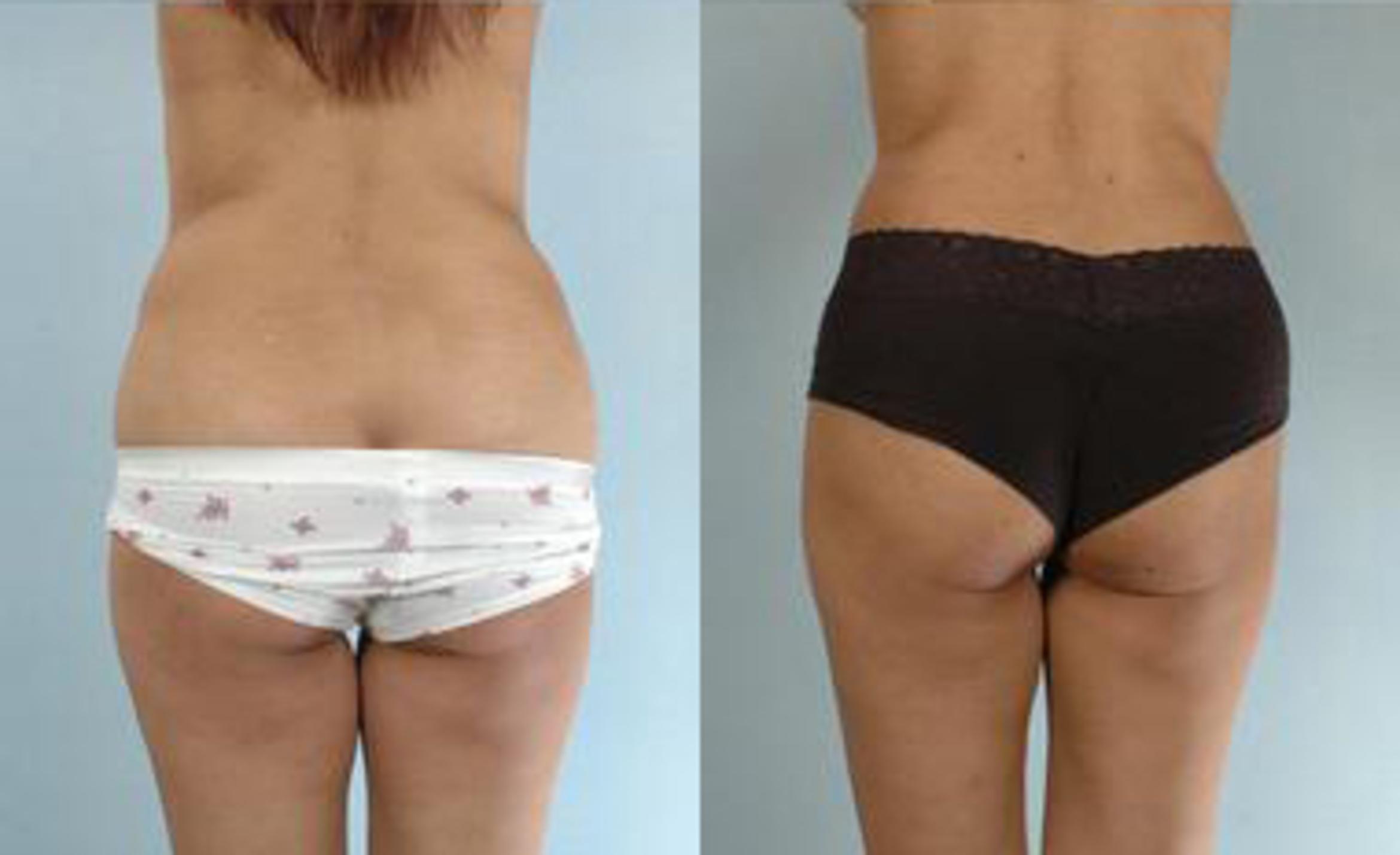 Before & After Liposuction Case 3283 View 4 View in Houston, TX