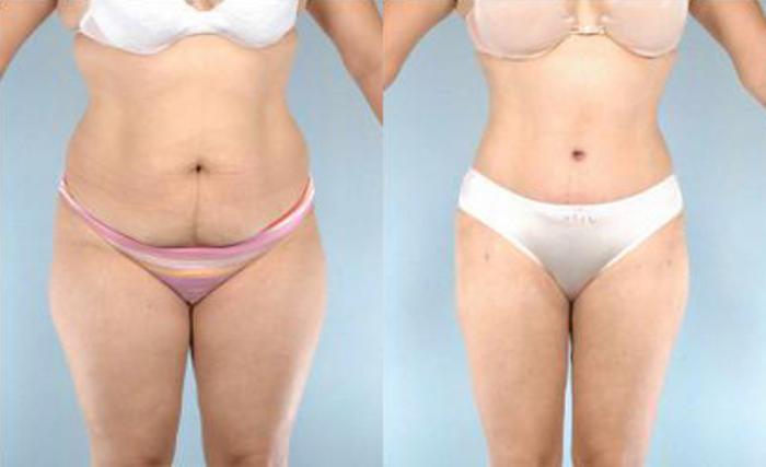 Before & After Liposuction Case 3293 View 1 View in Houston, TX