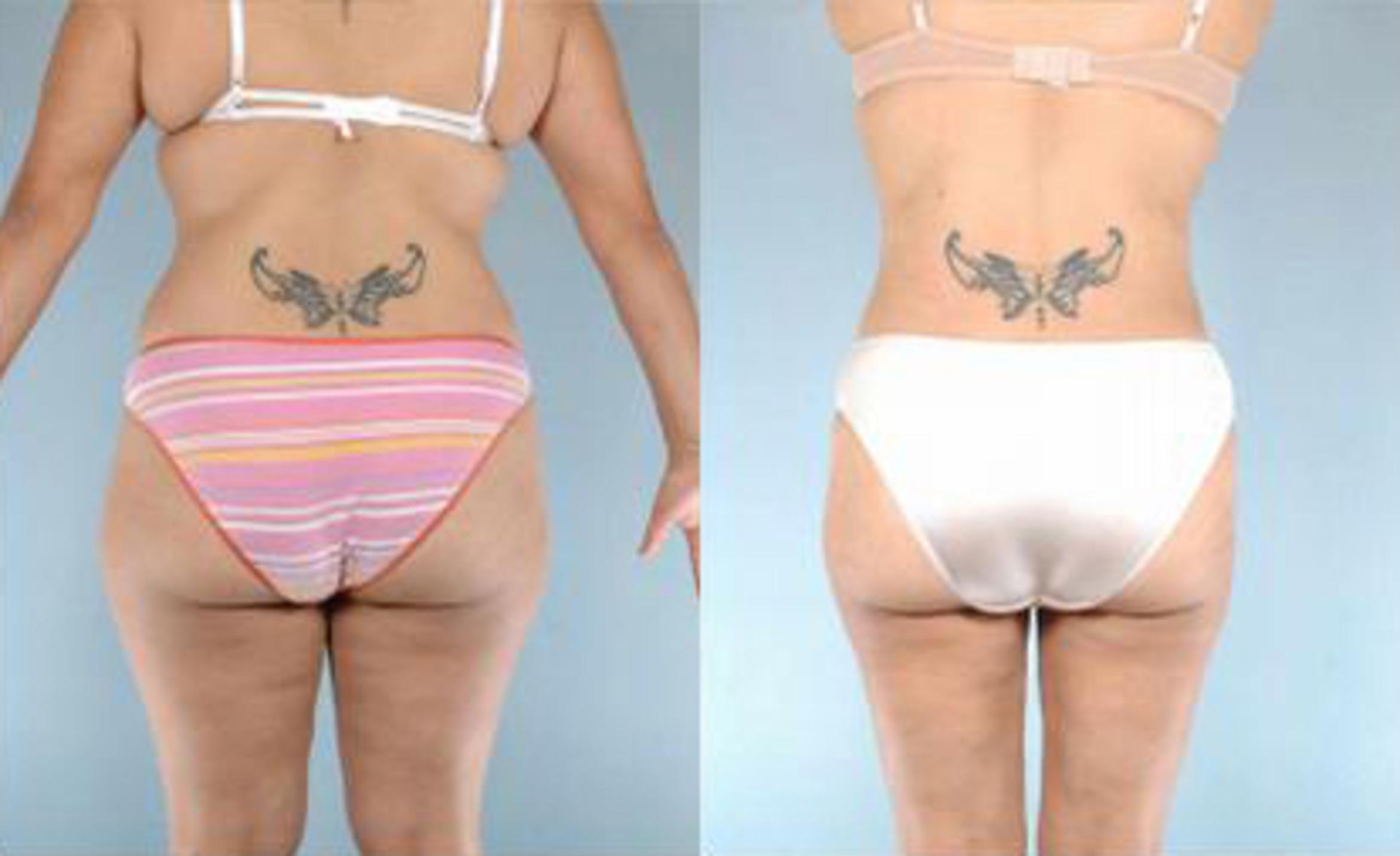 Before & After Liposuction Case 3293 View 3 View in Houston, TX