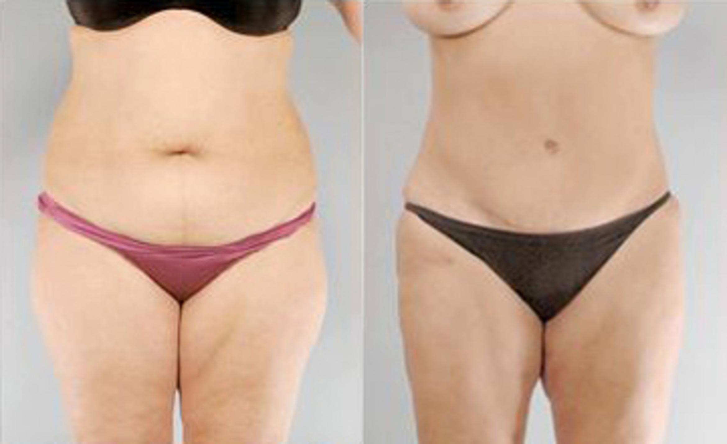 Before & After Liposuction Case 3301 View 1 View in Houston, TX