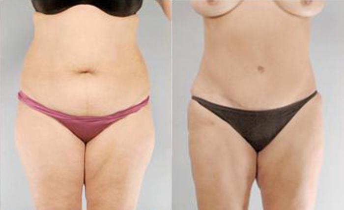 Before & After Liposuction Case 3301 View 1 View in Houston, TX