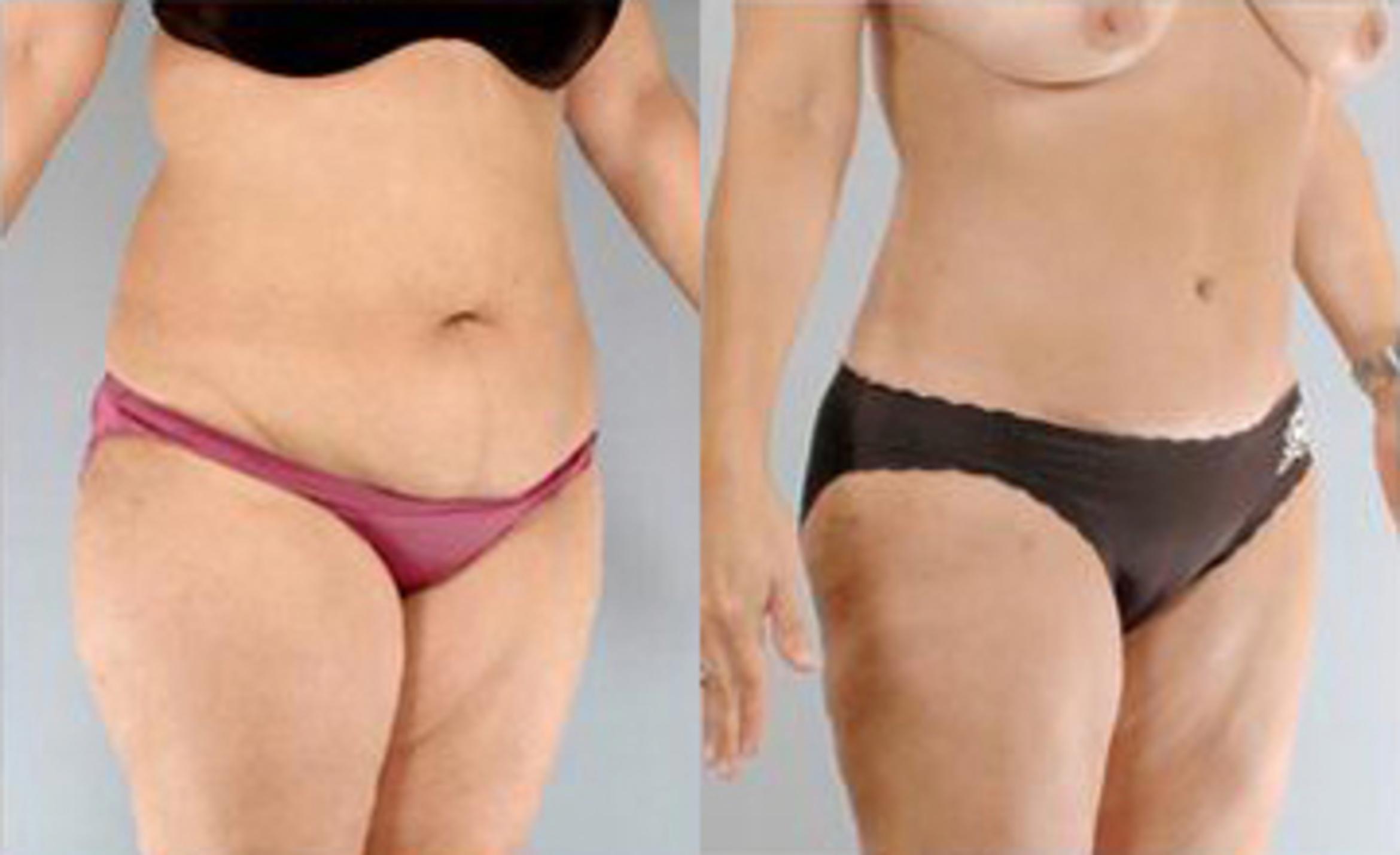 Before & After Liposuction Case 3301 View 2 View in Houston, TX