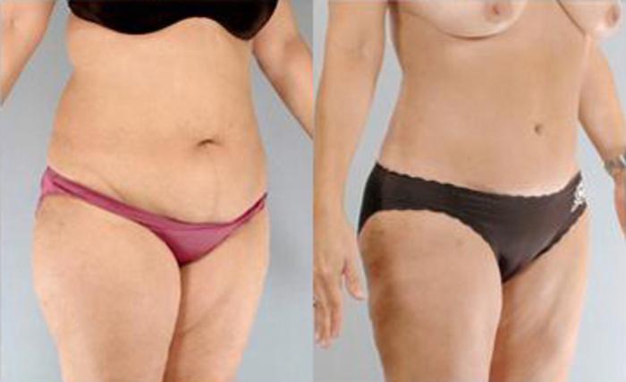 Before & After Liposuction Case 3301 View 2 View in Houston, TX