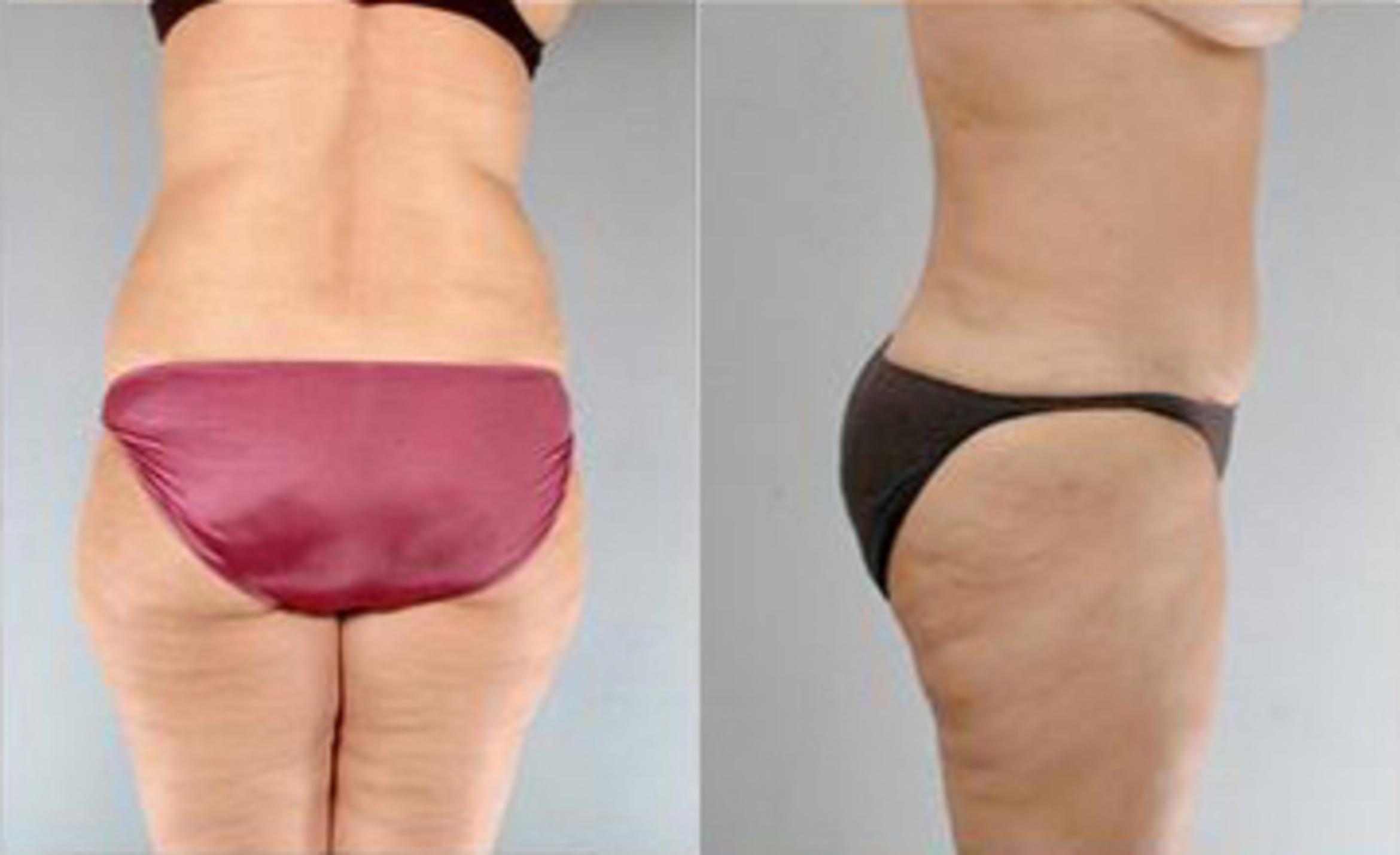 Before & After Liposuction Case 3301 View 3 View in Houston, TX