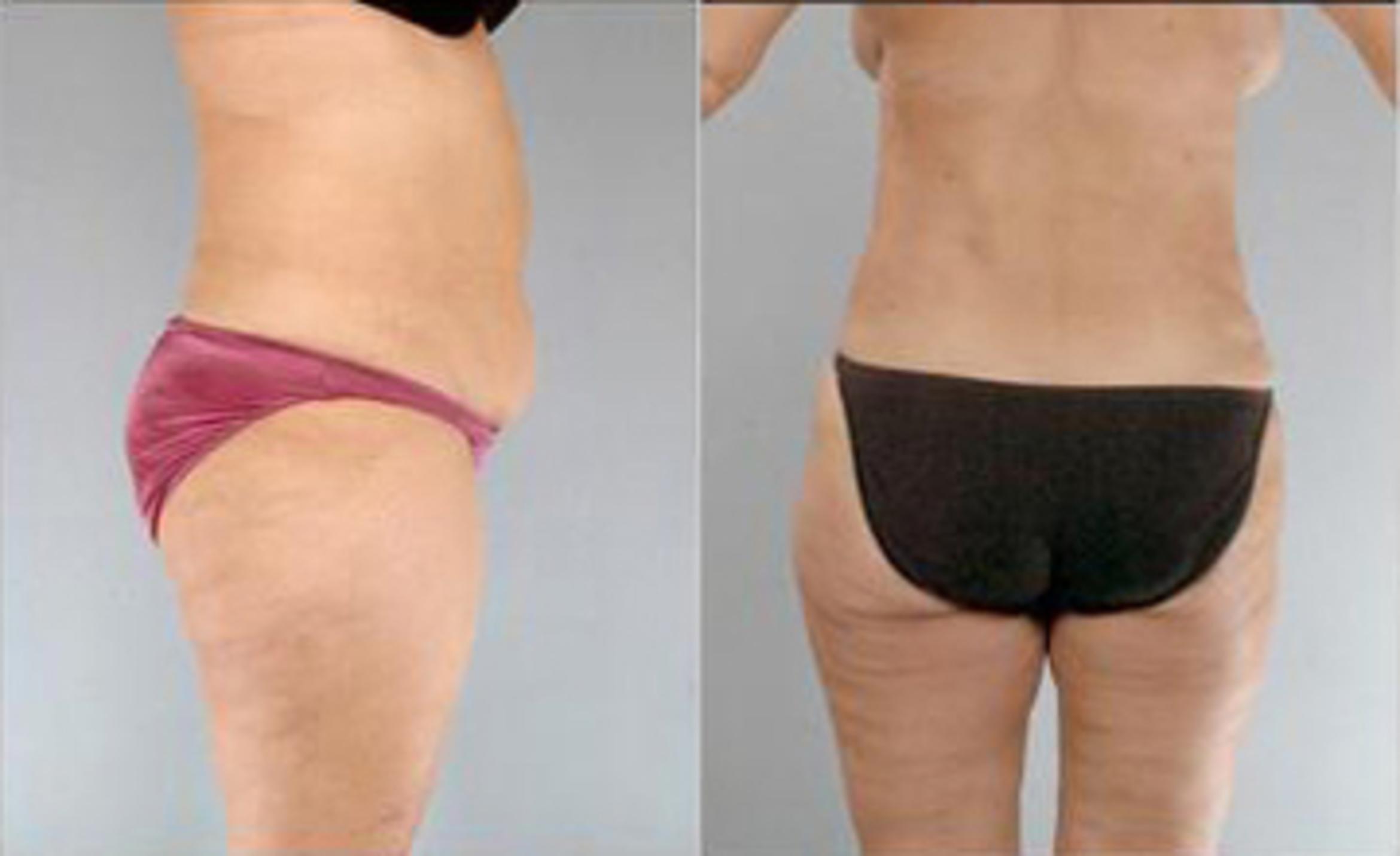 Before & After Liposuction Case 3301 View 4 View in Houston, TX