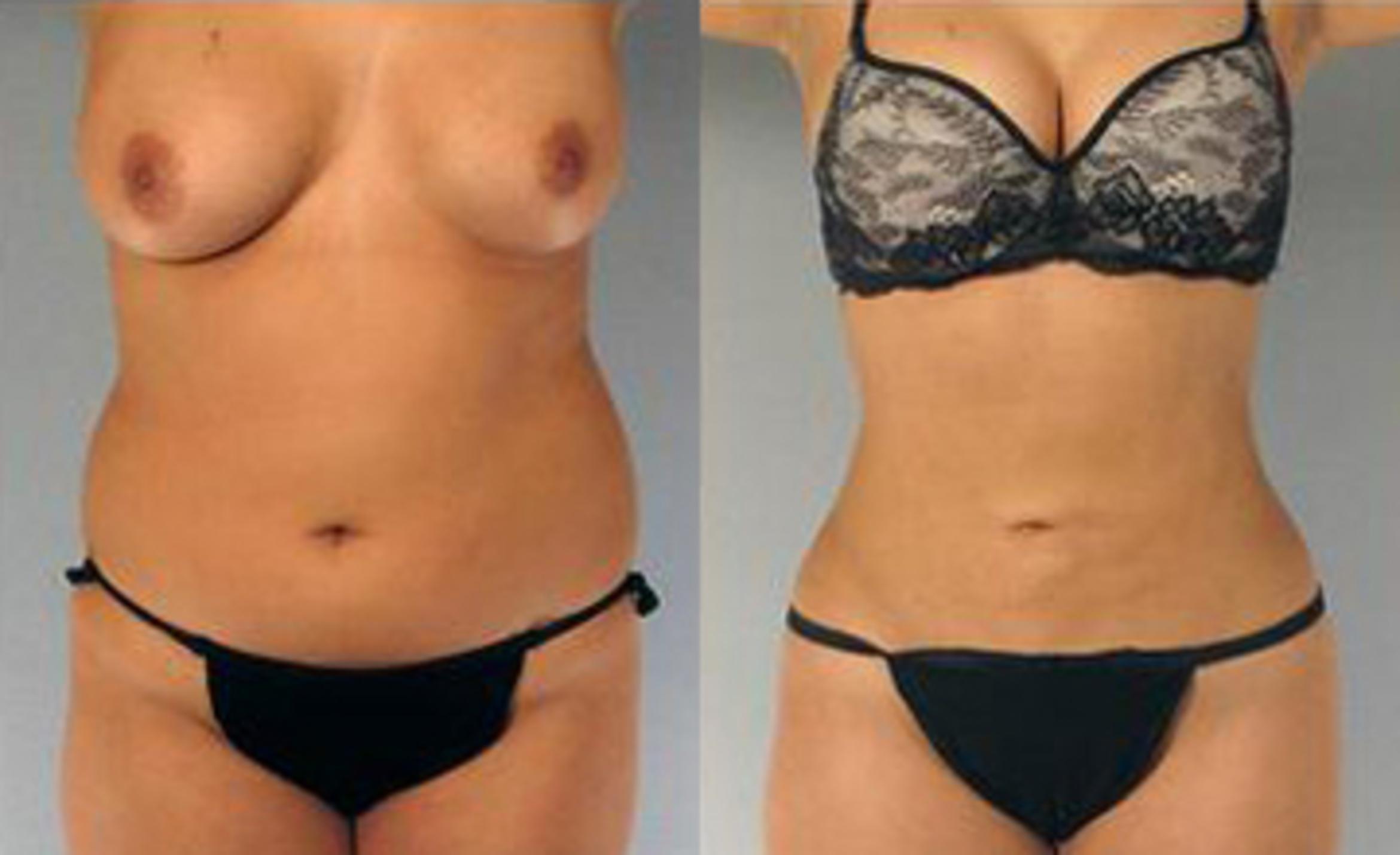 Before & After Liposuction Case 3311 View 1 View in Houston, TX