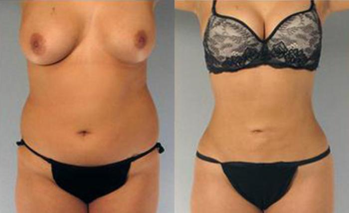 Before & After Liposuction Case 3311 View 1 View in Houston, TX