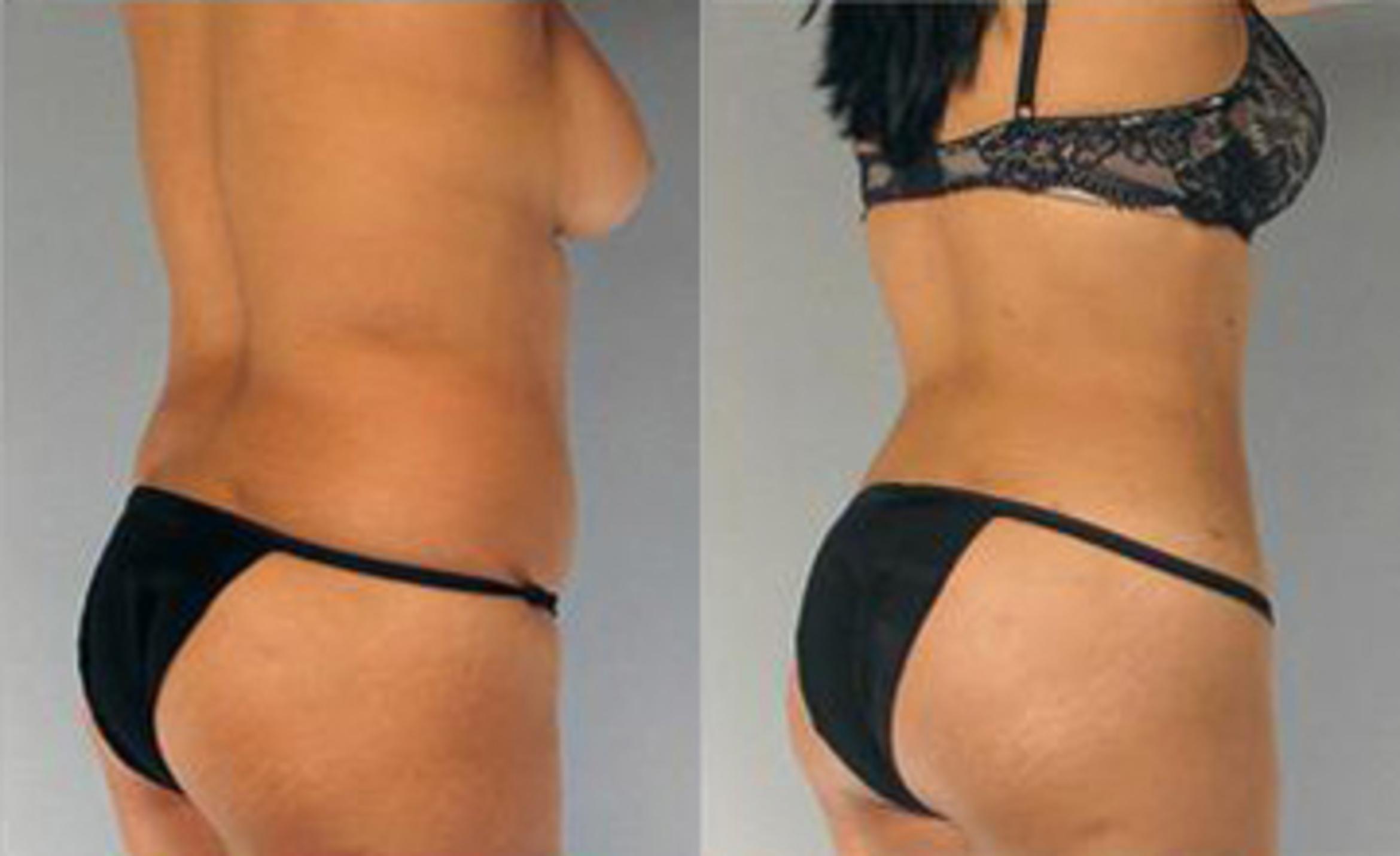 Before & After Liposuction Case 3311 View 2 View in Houston, TX
