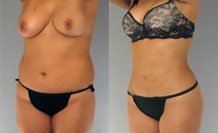Before & After Liposuction Case 3311 View 3 View in Houston, TX