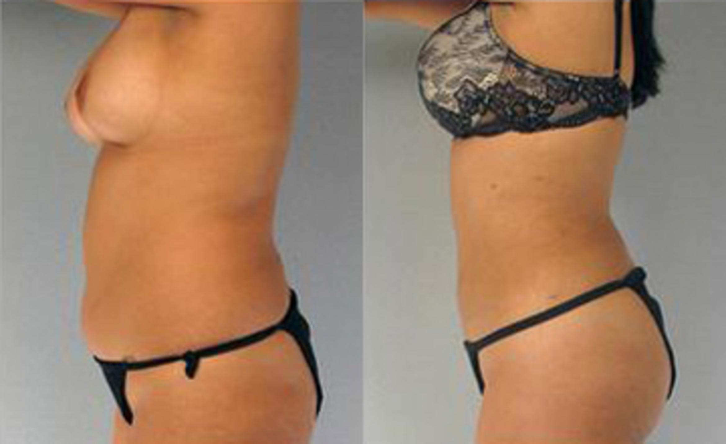 Before & After Liposuction Case 3311 View 4 View in Houston, TX