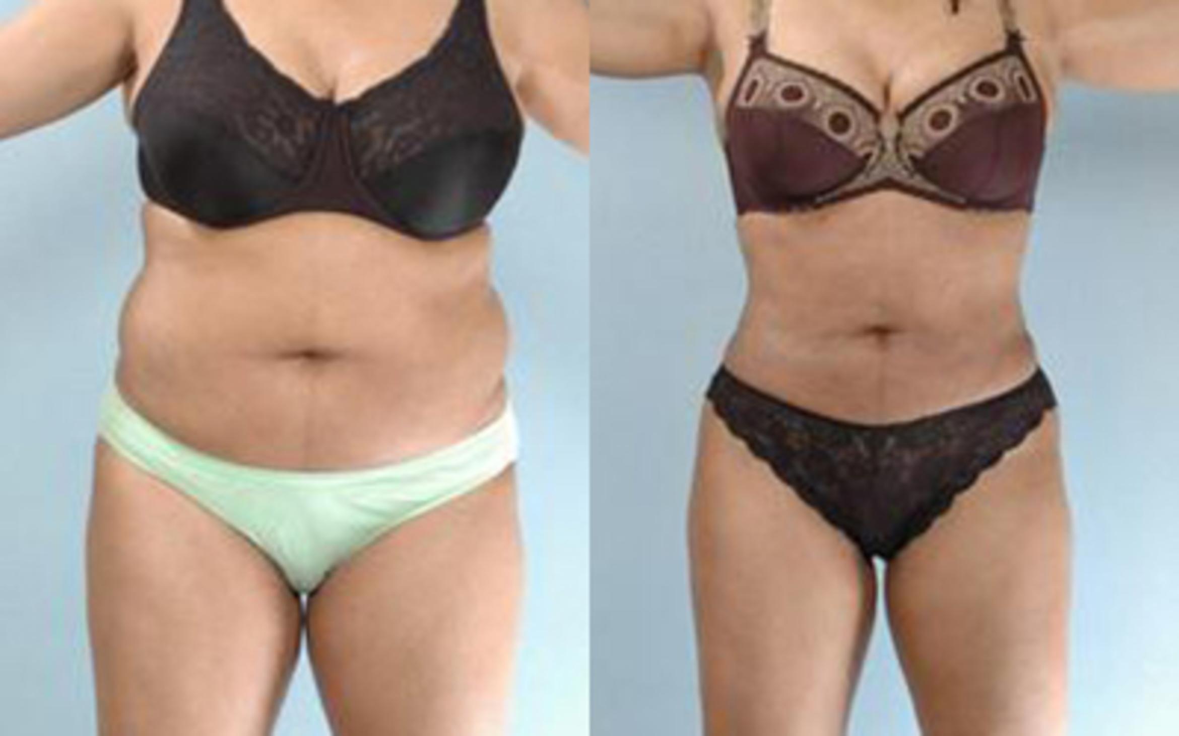 Before & After Liposuction Case 3321 View 1 View in Houston, TX