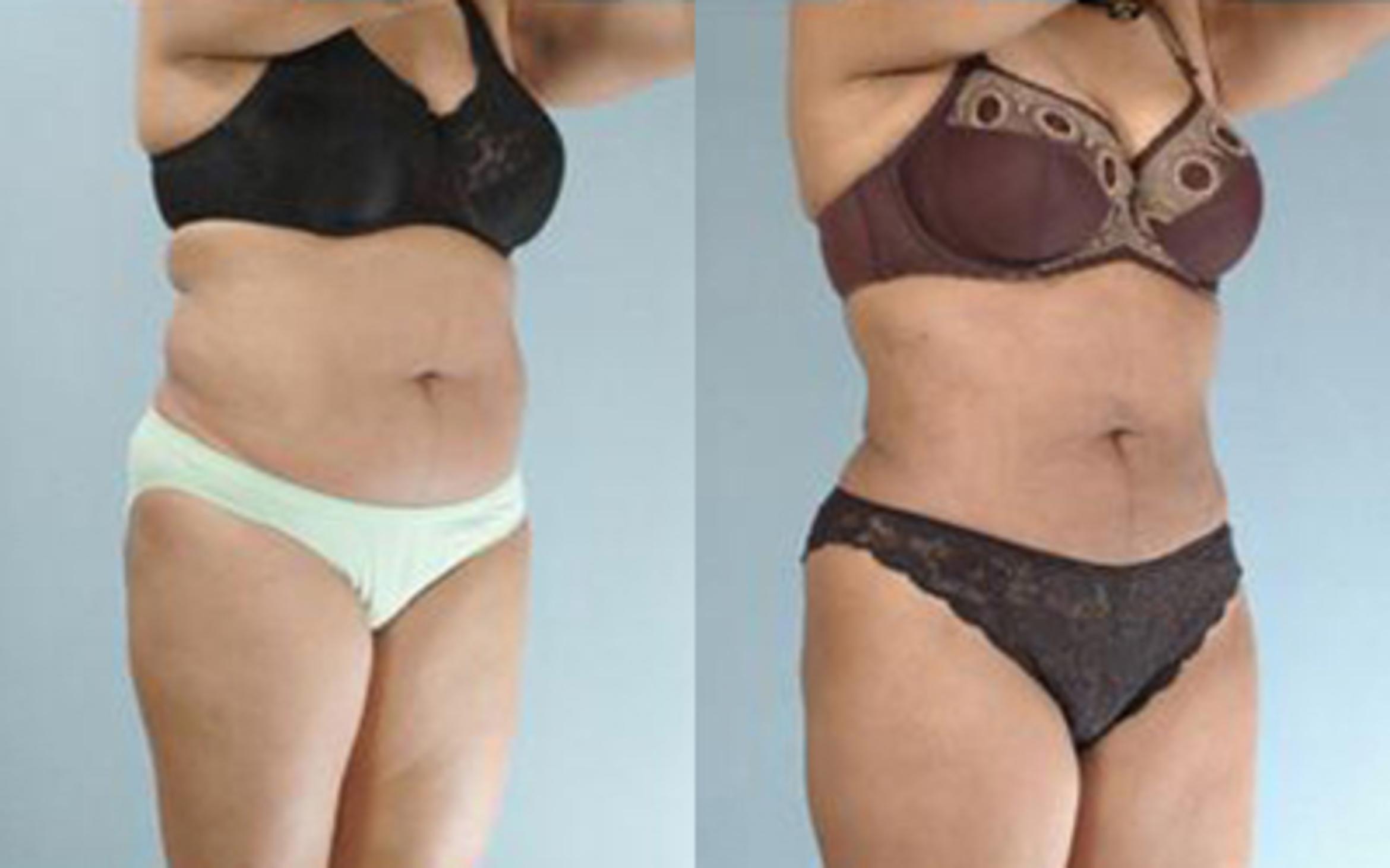 Before & After Liposuction Case 3321 View 2 View in Houston, TX