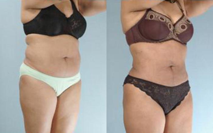 Before & After Liposuction Case 3321 View 2 View in Houston, TX