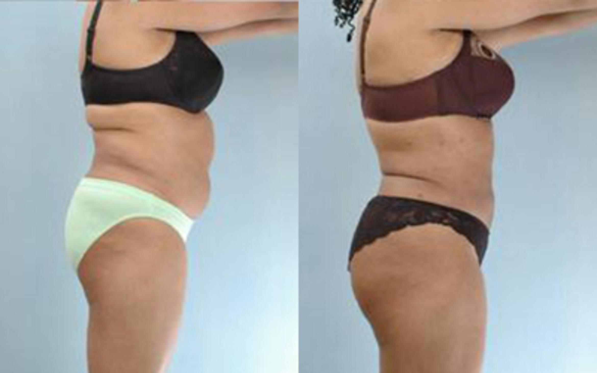 Before & After Liposuction Case 3321 View 3 View in Houston, TX