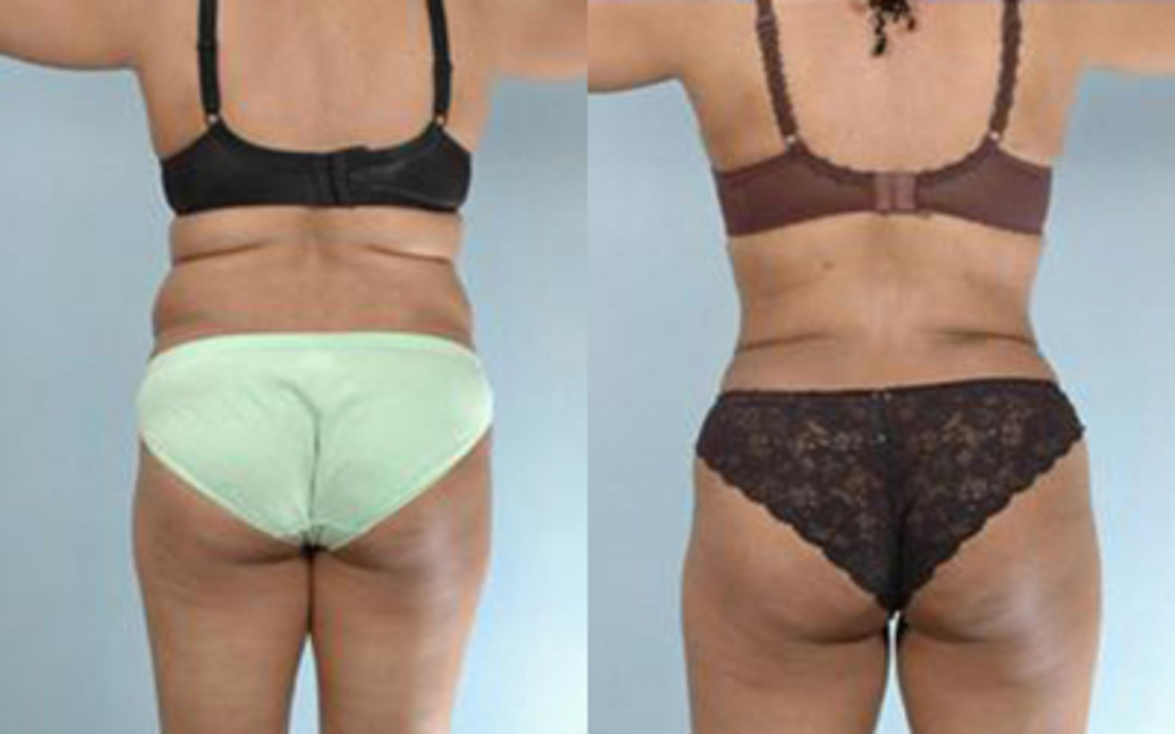 Before & After Liposuction Case 3321 View 4 View in Houston, TX
