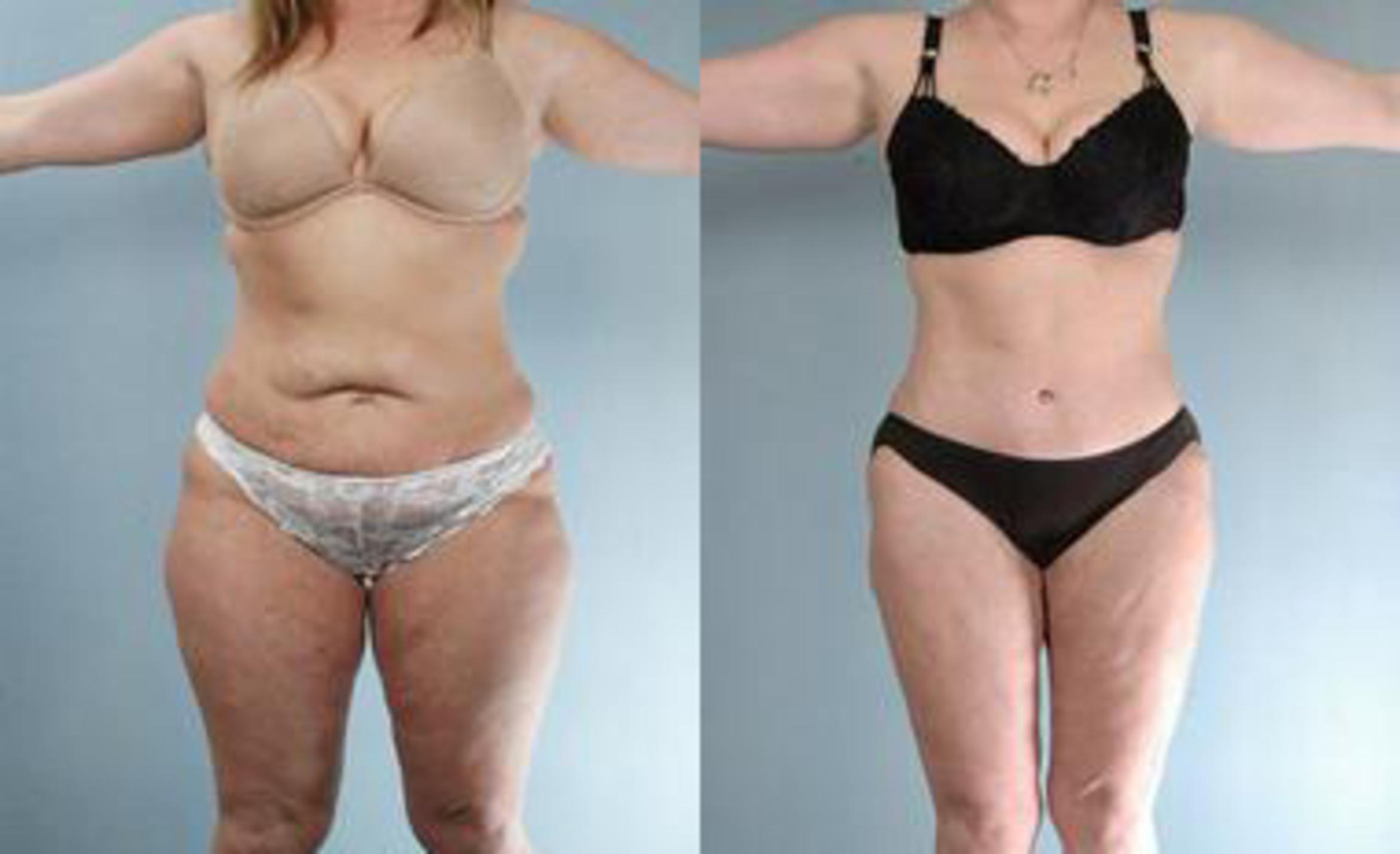 Before & After Liposuction Case 3331 View 1 View in Houston, TX