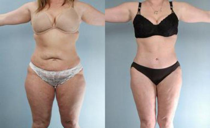 Before & After Liposuction Case 3331 View 1 View in Houston, TX