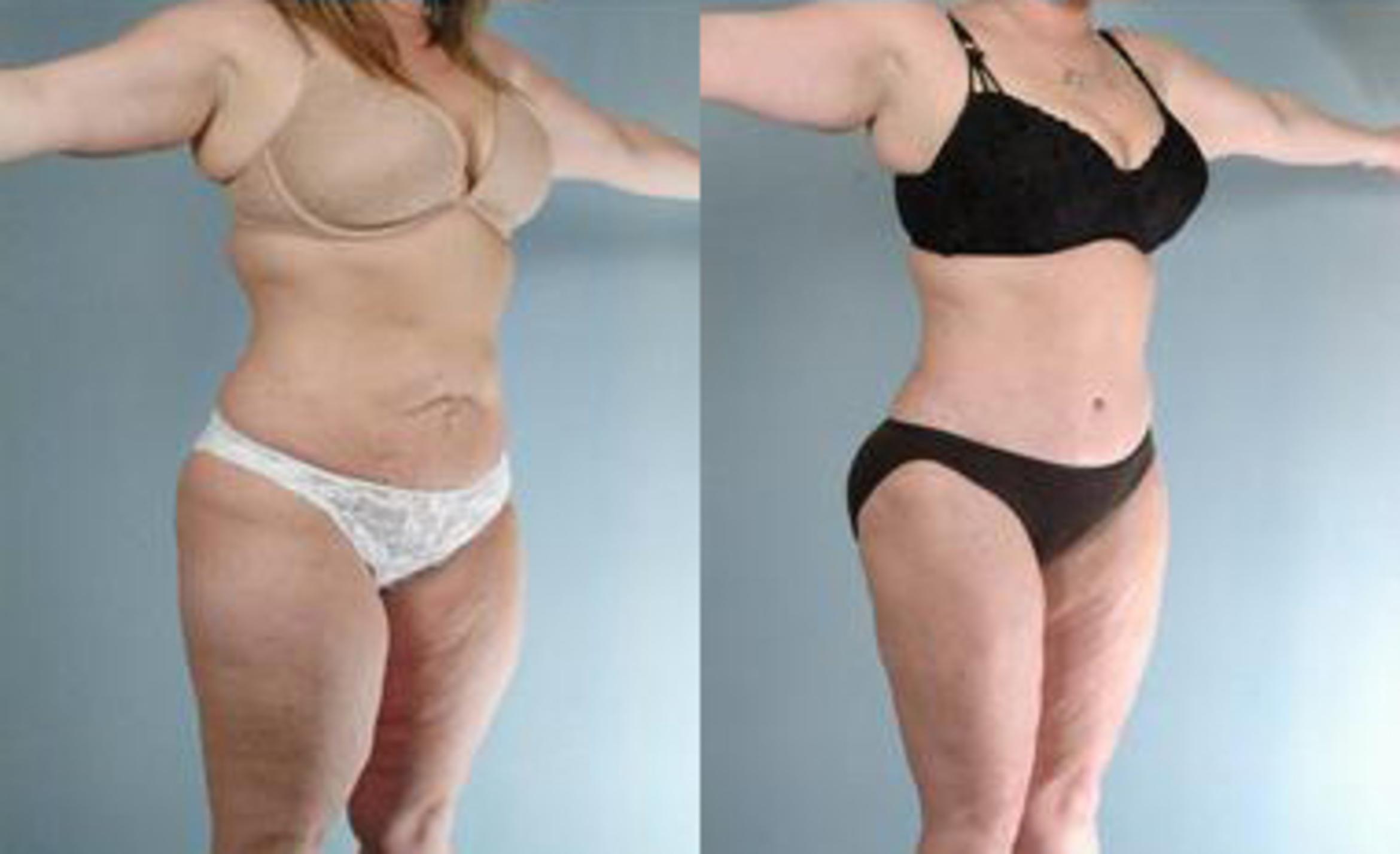 Before & After Liposuction Case 3331 View 2 View in Houston, TX
