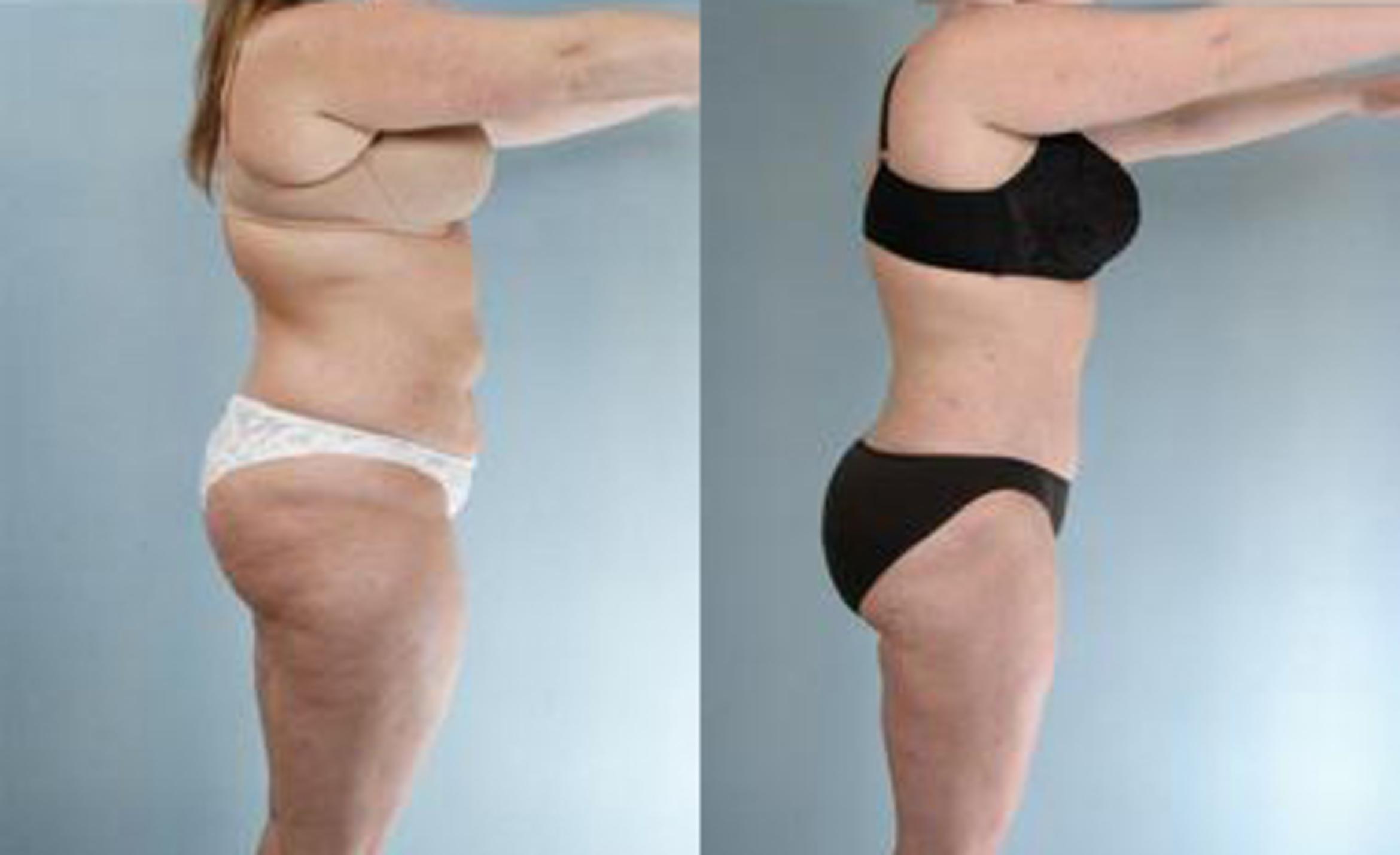 Before & After Liposuction Case 3331 View 3 View in Houston, TX