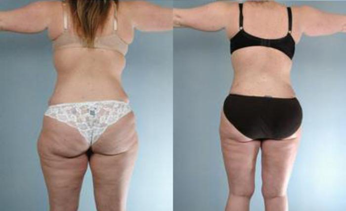 Before & After Liposuction Case 3331 View 4 View in Houston, TX