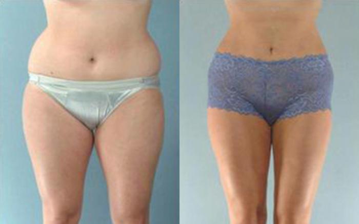 Before & After Liposuction Case 3341 View 1 View in Houston, TX