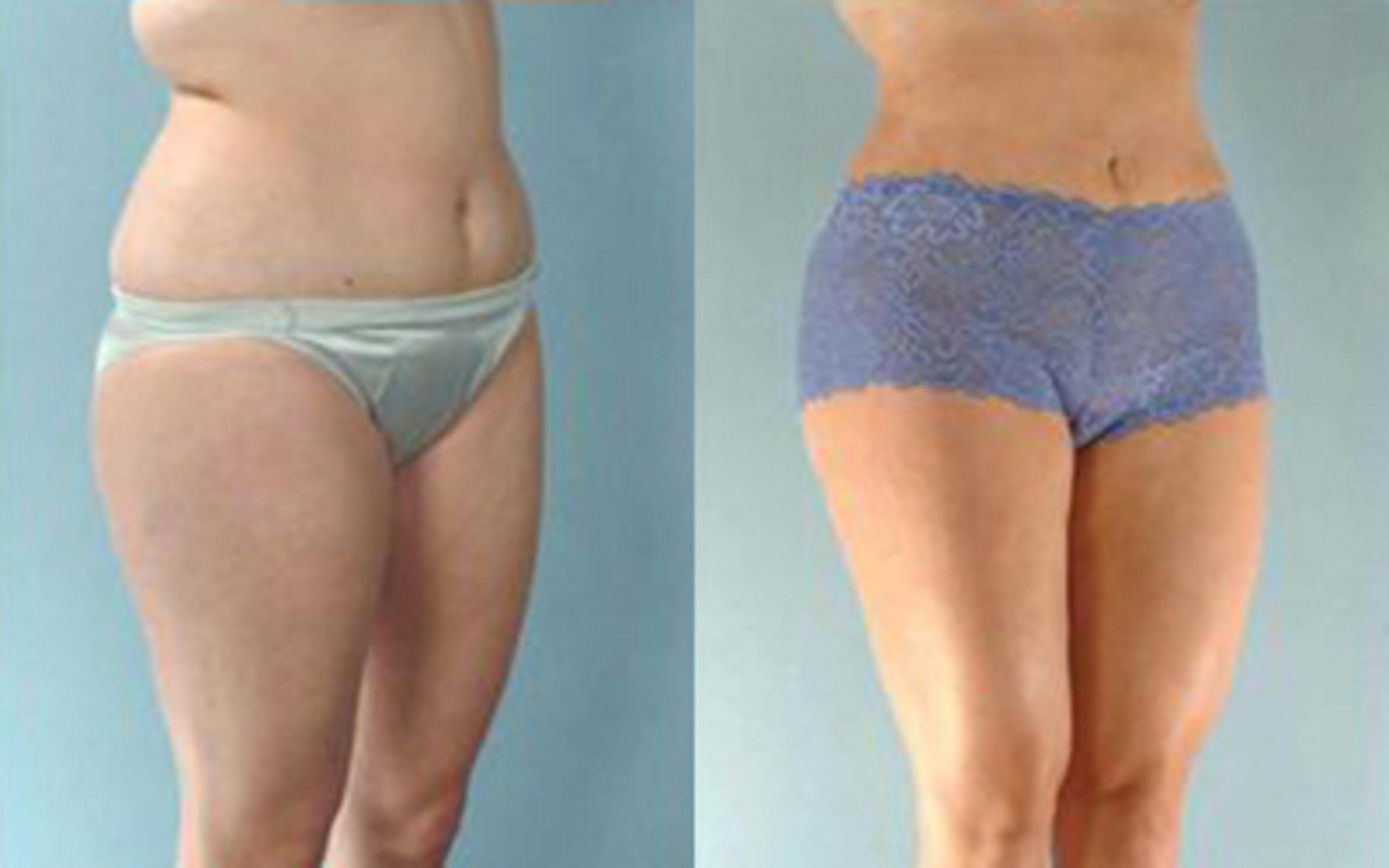 Before & After Liposuction Case 3341 View 2 View in Houston, TX