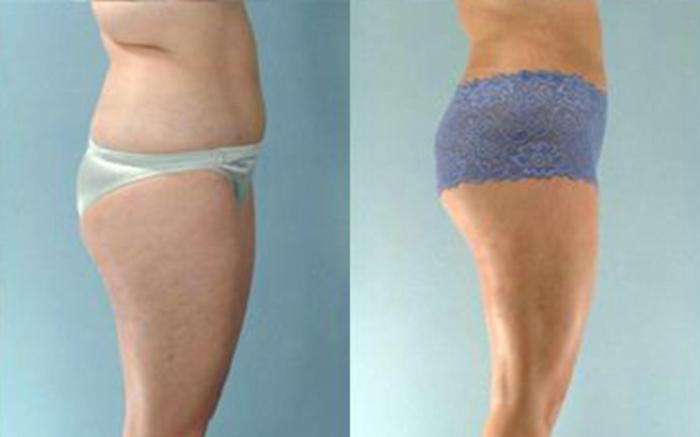 Before & After Liposuction Case 3341 View 3 View in Houston, TX