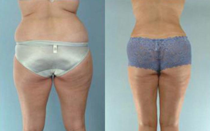 Before & After Liposuction Case 3341 View 4 View in Houston, TX
