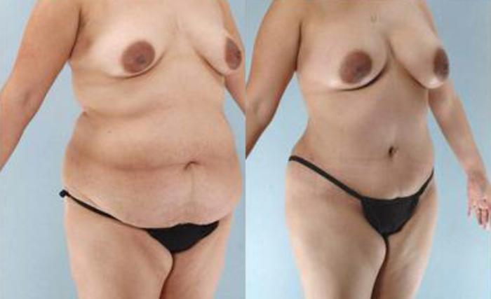 Before & After Liposuction Case 3351 View 2 View in Houston, TX