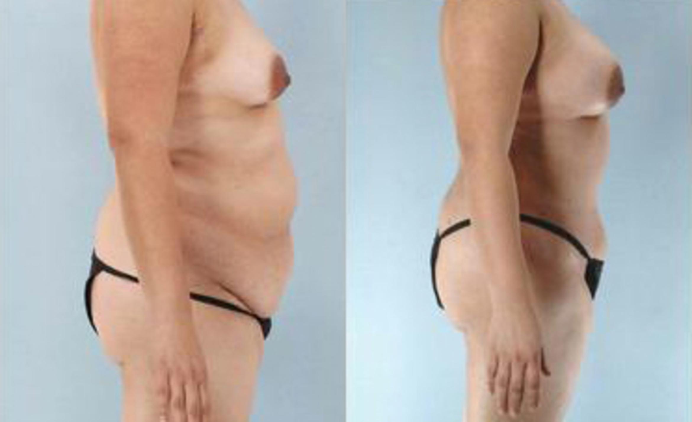 Before & After Liposuction Case 3351 View 3 View in Houston, TX