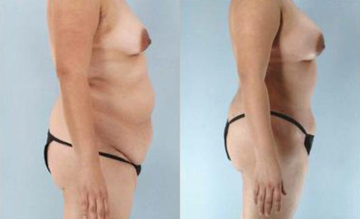 Before & After Liposuction Case 3351 View 3 View in Houston, TX