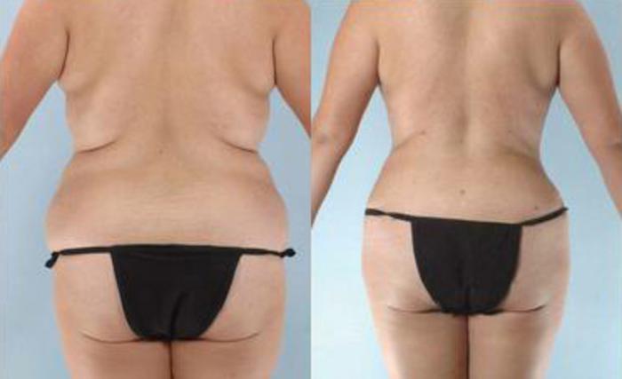 Before & After Liposuction Case 3351 View 4 View in Houston, TX