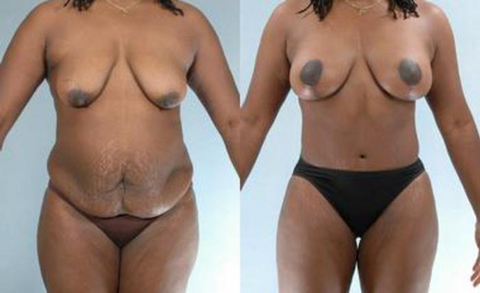 Before & After Liposuction Case 3361 View 1 View in Houston, TX