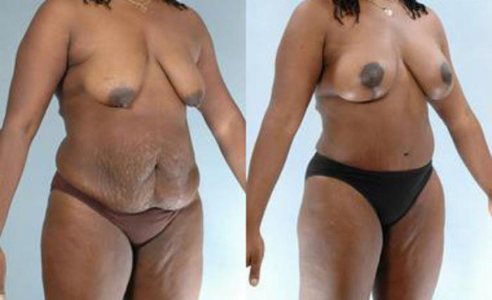 Before & After Liposuction Case 3361 View 2 View in Houston, TX