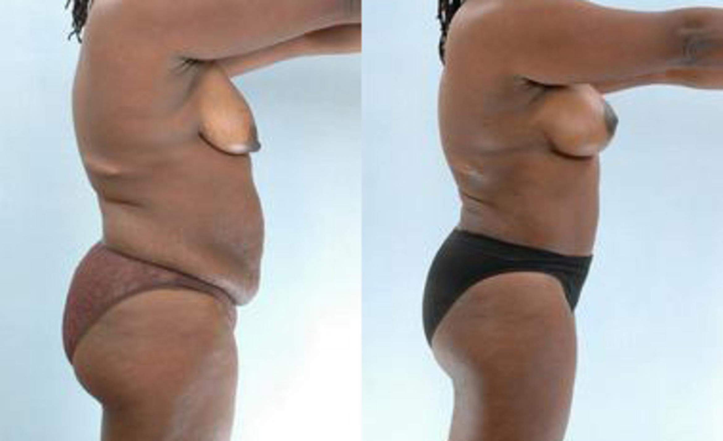 Before & After Liposuction Case 3361 View 3 View in Houston, TX