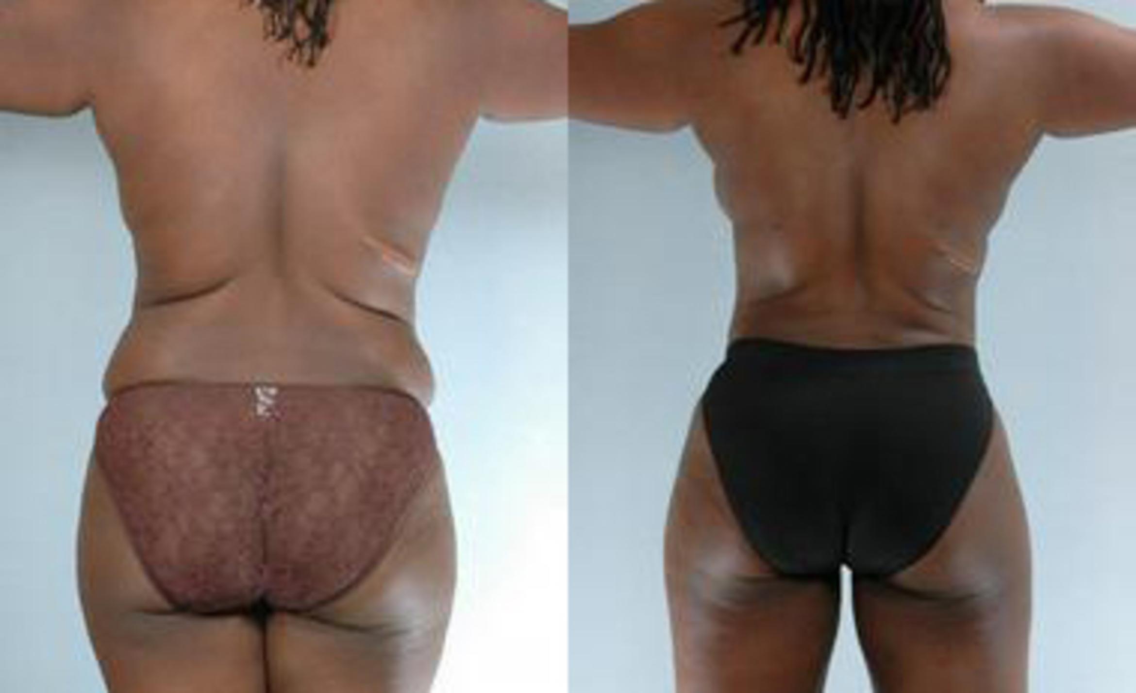 Before & After Liposuction Case 3361 View 4 View in Houston, TX