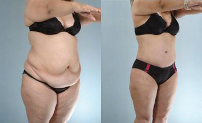 Before & After Liposuction Case 3371 View 2 View in Houston, TX