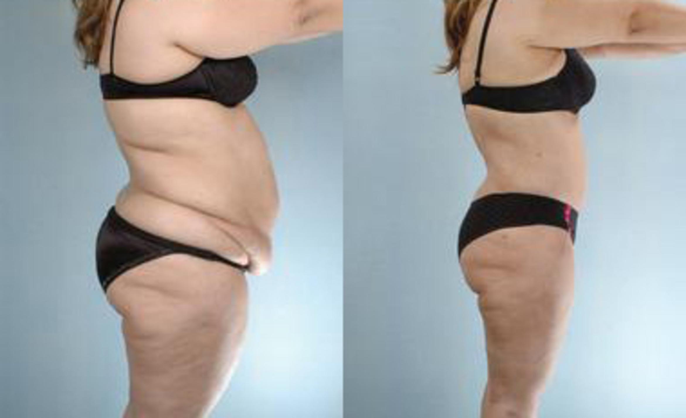 Before & After Liposuction Case 3371 View 3 View in Houston, TX