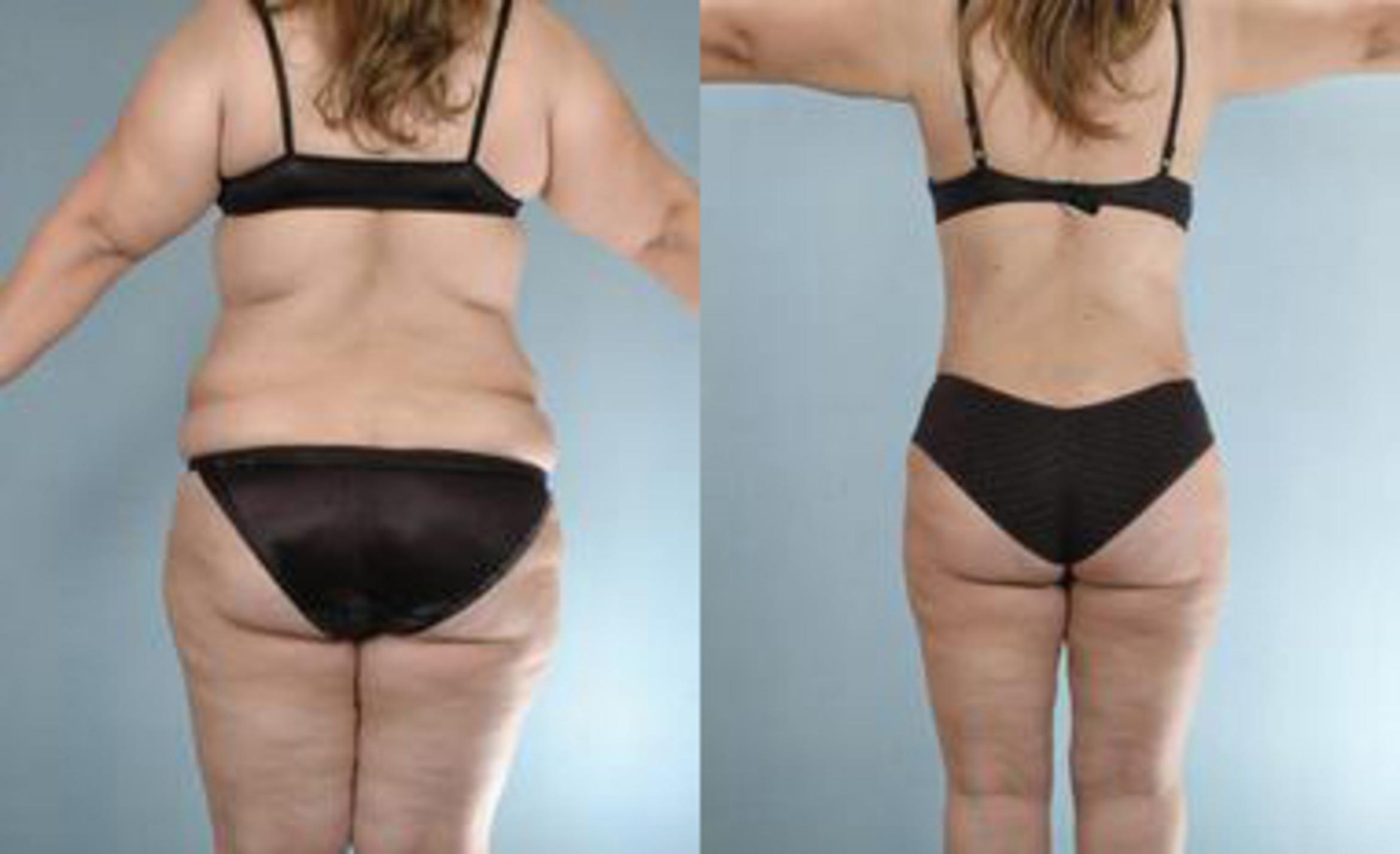 Before & After Liposuction Case 3371 View 4 View in Houston, TX