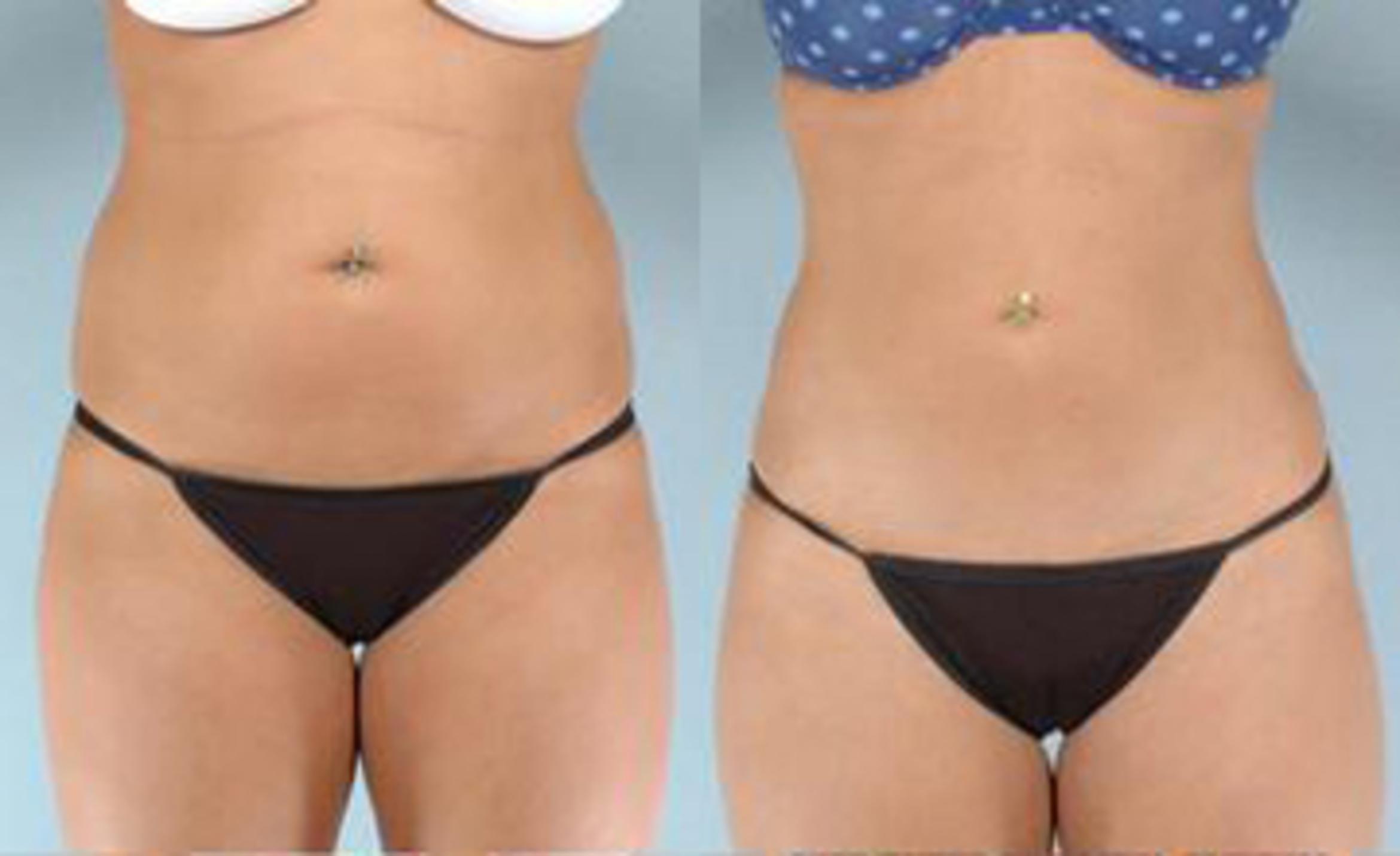 Before & After Liposuction Case 3381 View 1 View in Houston, TX