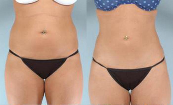 Before & After Liposuction Case 3381 View 1 View in Houston, TX