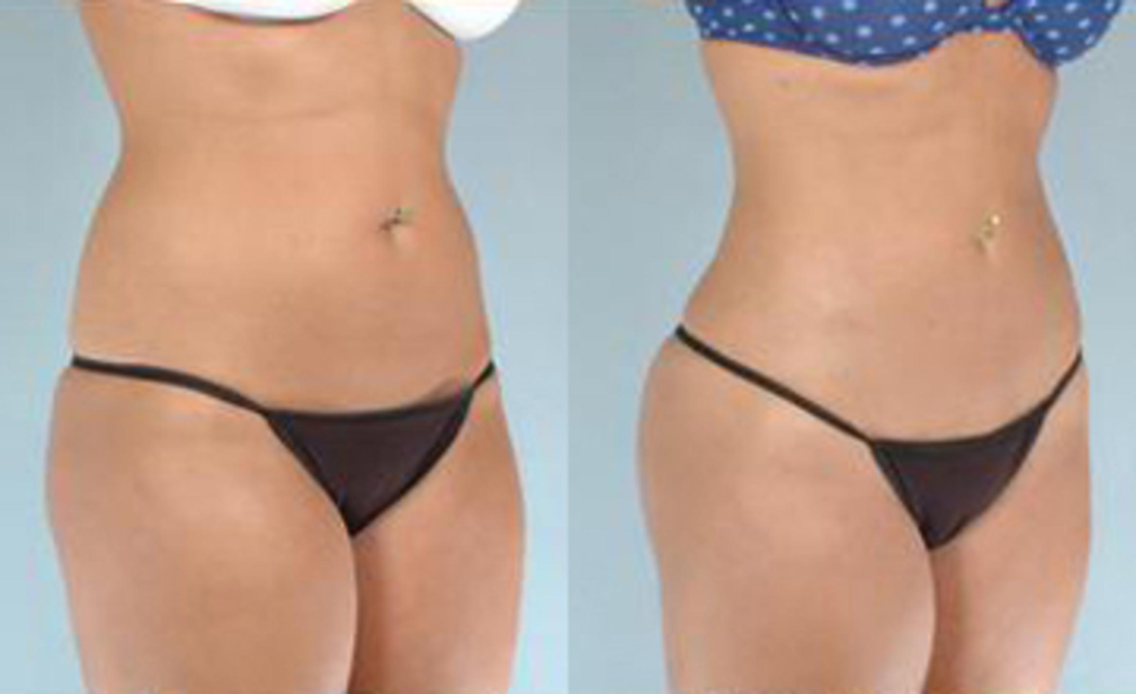 Before & After Liposuction Case 3381 View 2 View in Houston, TX