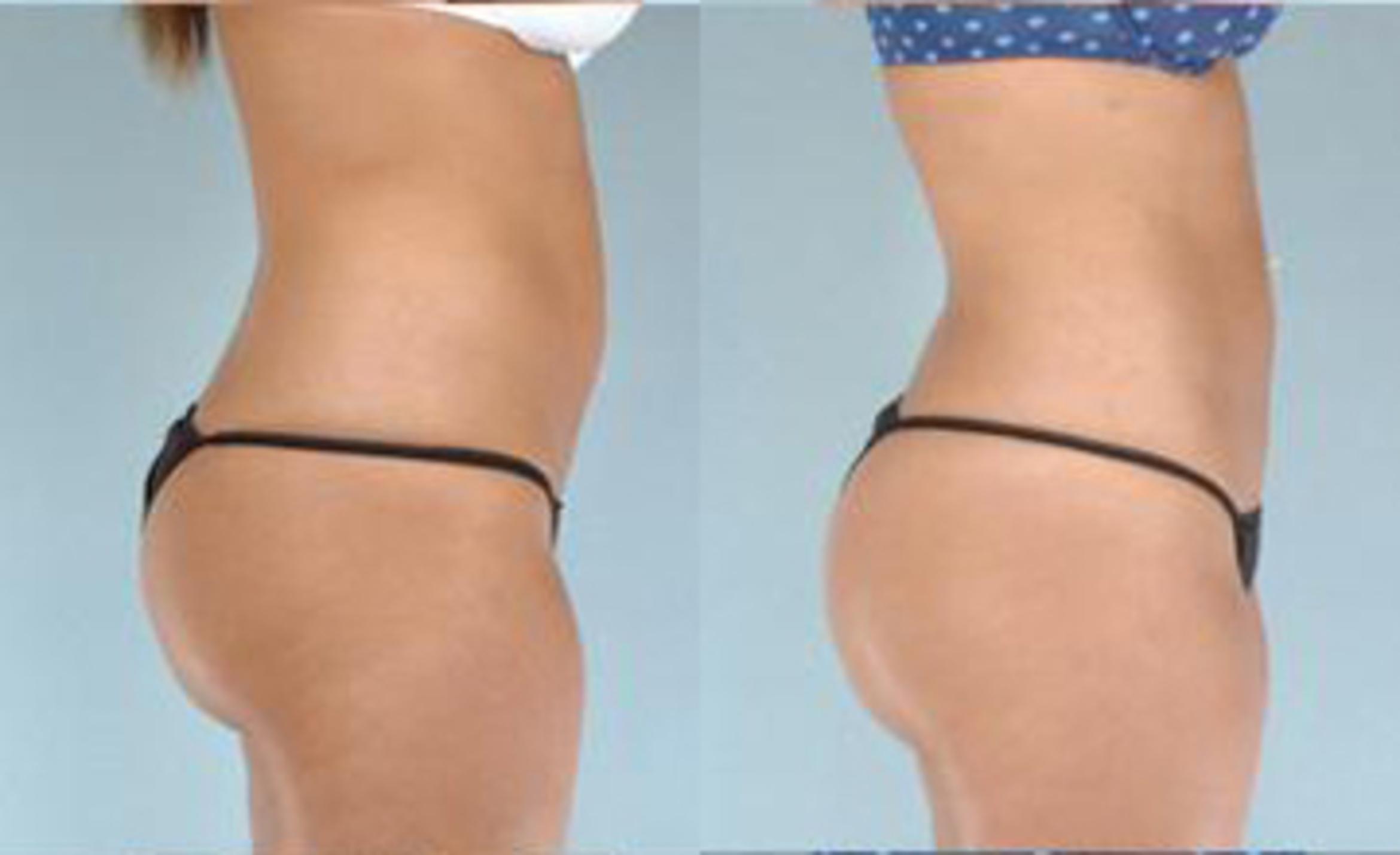 Before & After Liposuction Case 3381 View 3 View in Houston, TX