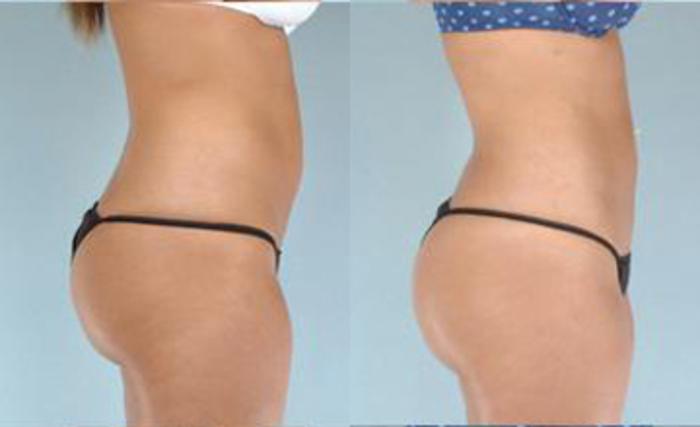 Before & After Liposuction Case 3381 View 3 View in Houston, TX