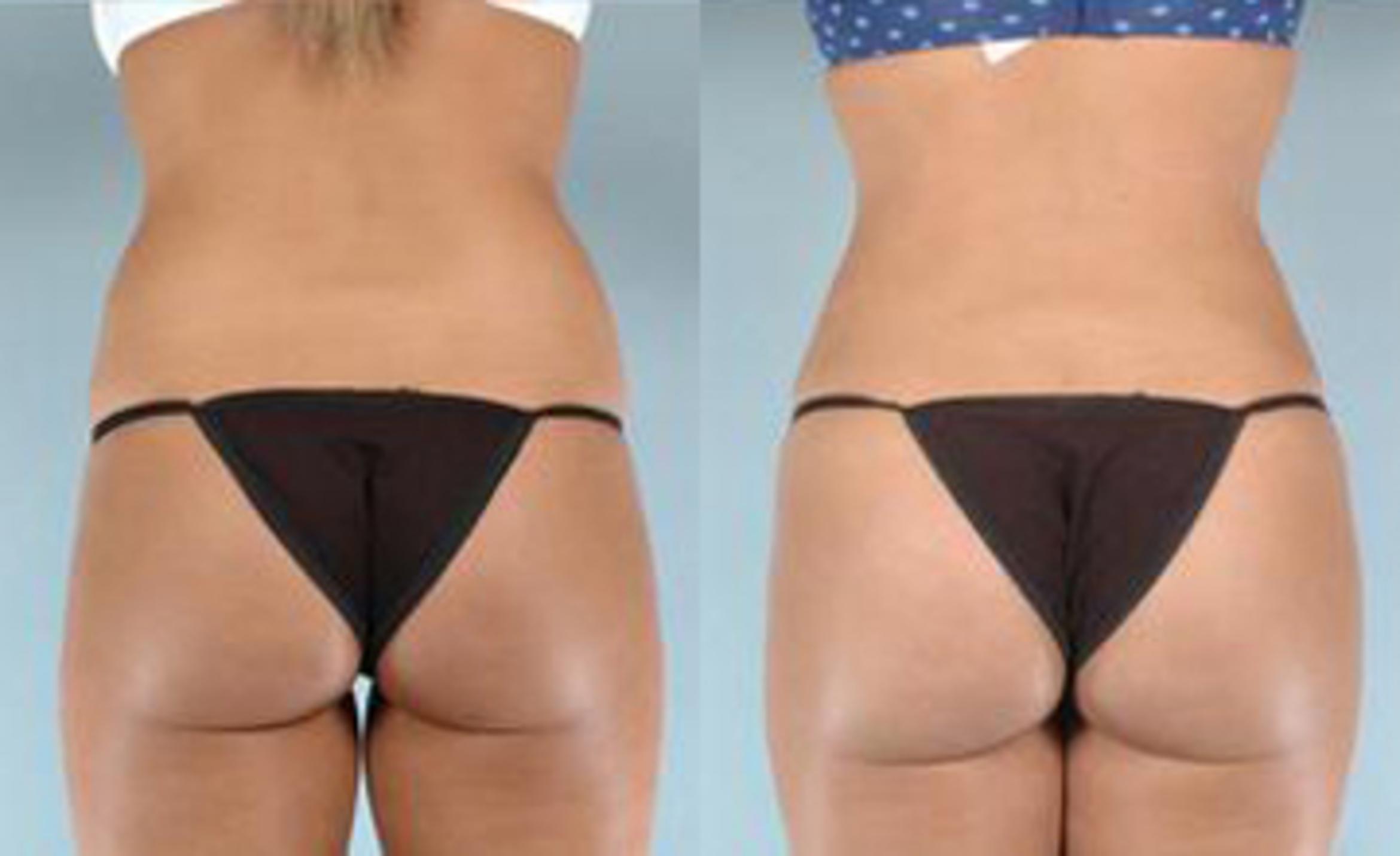 Before & After Liposuction Case 3381 View 4 View in Houston, TX