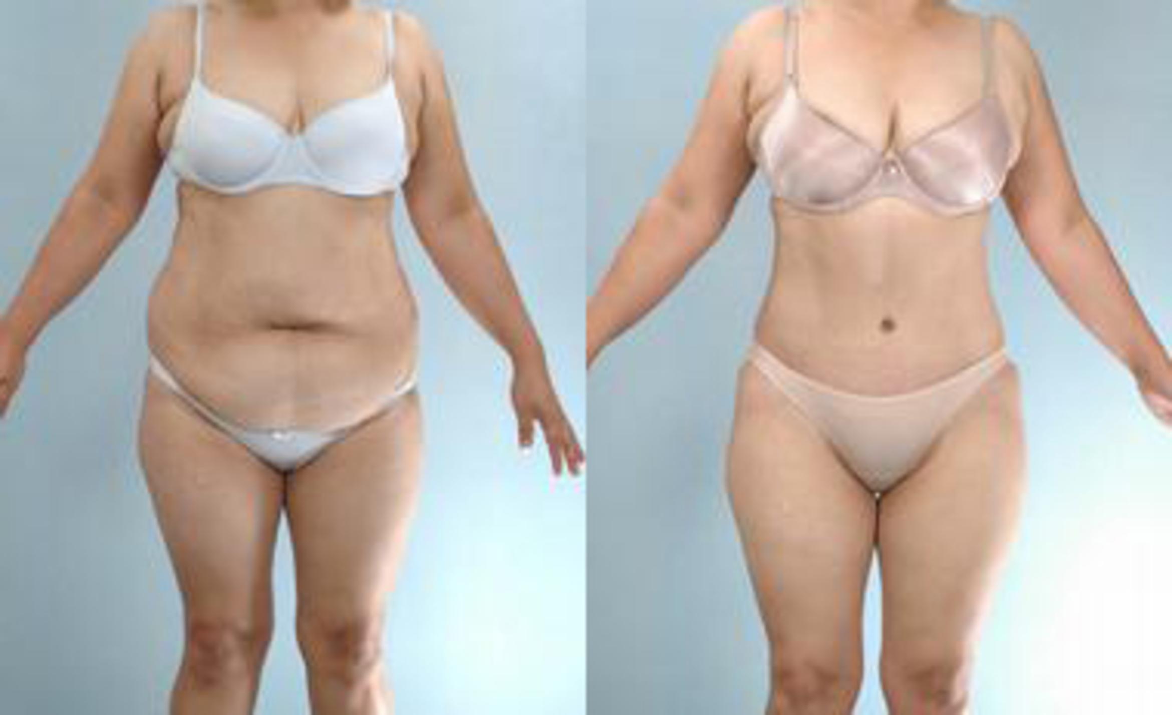 Before & After Liposuction Case 3391 View 1 View in Houston, TX